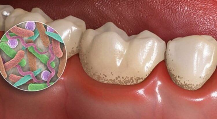 Из-за чего возникает кариес и как защитить зубы?