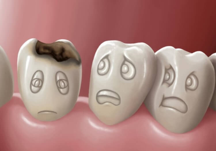 Из-за чего возникает кариес и как защитить зубы?