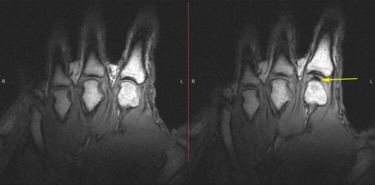 Почему хрустят пальцы? МРТ сканирование пальцев добровольца во время «хруста». На изображениях можно увидеть внезапное появление выпуклости в суставе, когда тот «захрустел». Фото.
