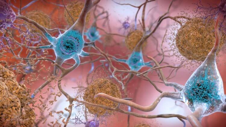 Многообещающие открытия. Клубки тау-белков вторгаются в здоровые клетки мозга, являясь одной из причин развития болезни Альцгеймера. Фото.