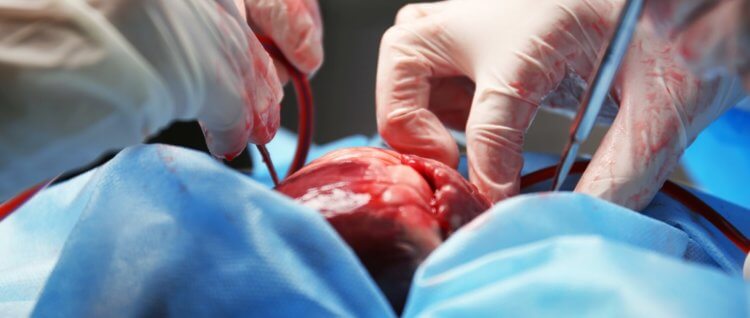Как проходит трансплантация сердца у взрослых и детей? Сегодня в мире проводится около 3500 операций по пересадке сердца в год. Фото.