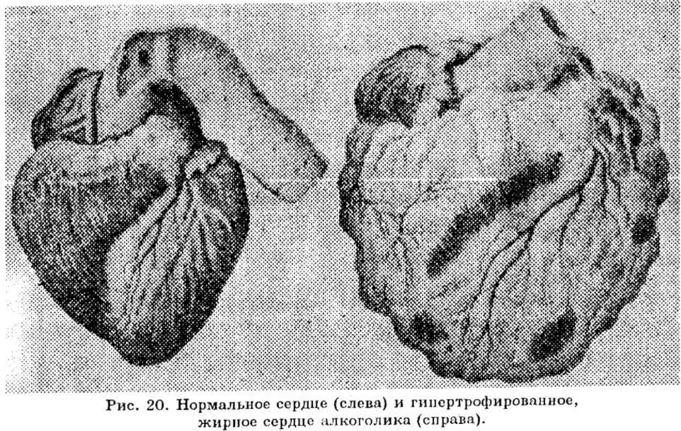 Улучшение работы сердца. Сердце здорового человека и алкоголика. Фото.
