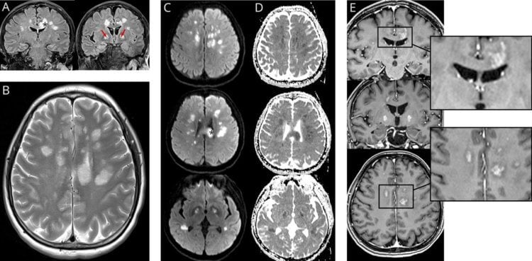 Как COVID-19 влияет на мозг? МРТ-скан мозга пациента с COVID-19. Данные исследования 2020 года, опубликованы в журнале Neurology. Фото.