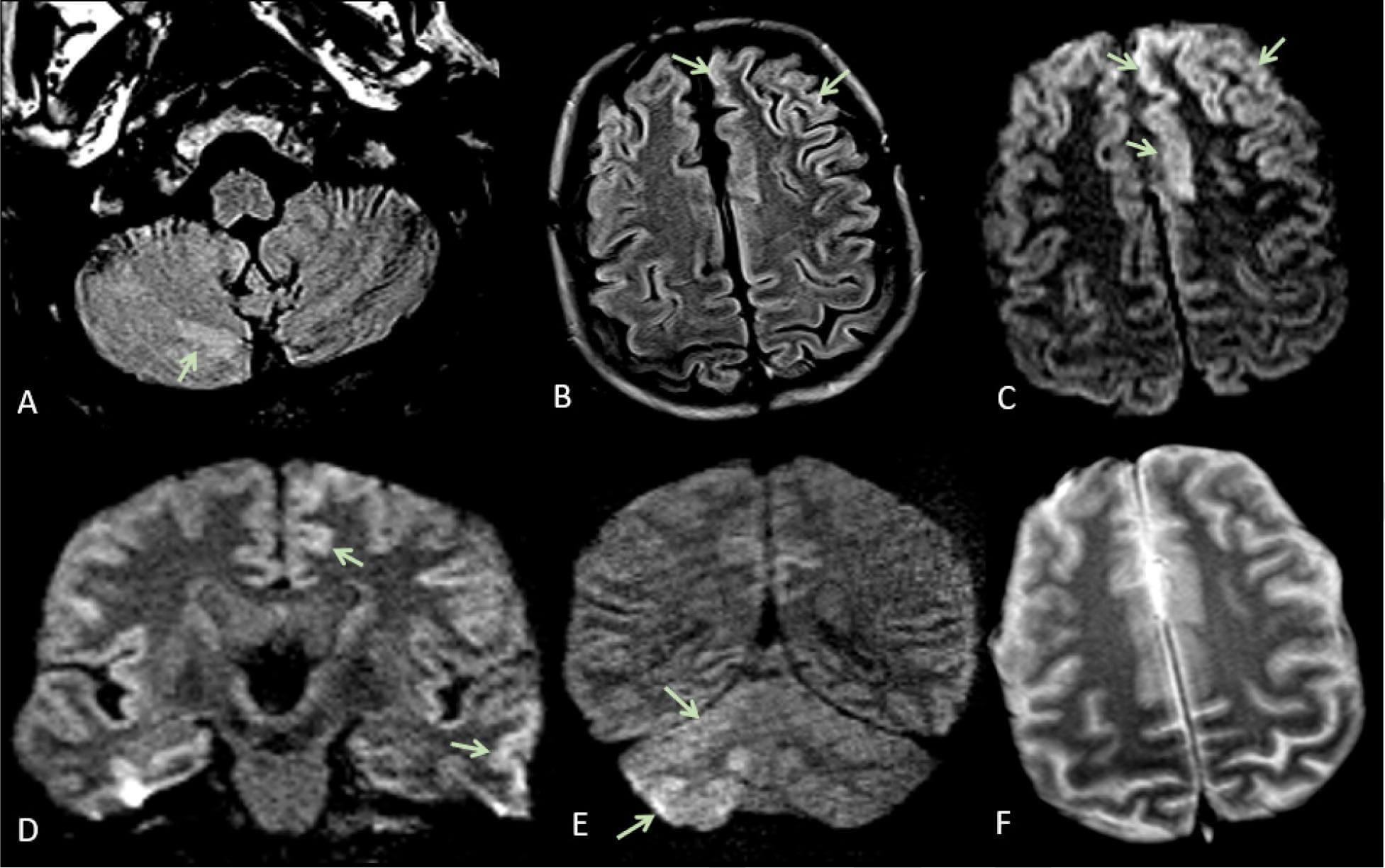 МРТ-снимки мозга пациента с подтвержденным COVID-19. Фото.