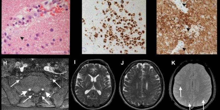 Коронавирус способствует исчезновению серого вещества в мозге. Что нужно знать? Выжившие после COVID-19 могут страдать от потери серого вещества и других тканей мозга с течением времени. Фото.