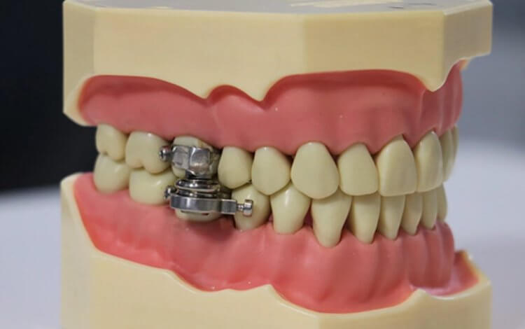 Разработан «замок» для рта, помогающий похудеть. Устройство для похудения DentalSlim выглядит как средневековое орудие пыток. Фото.