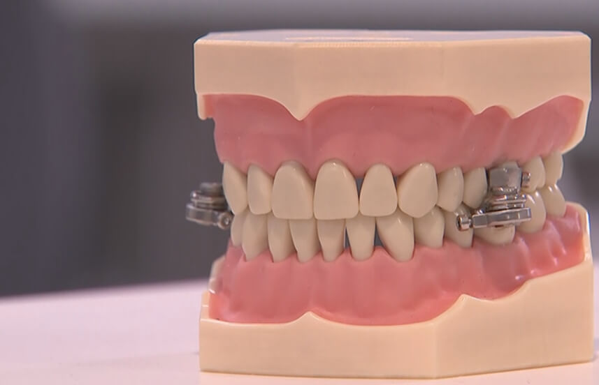 Экстремальный метод похудения. При ношении DentalSlim получится употреблять только жидкую пищу. Фото.