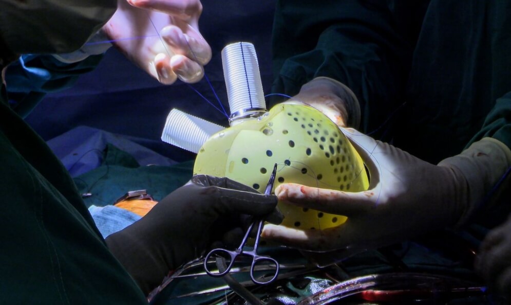 Искусственное сердце в руках хирургов. Фото.