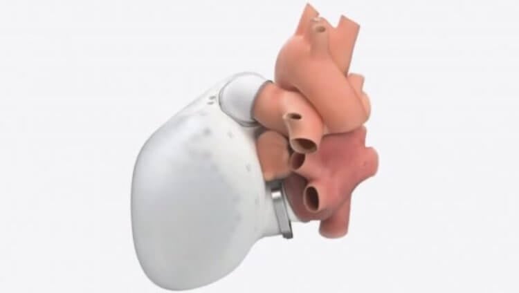 Особенности искусственного сердца. 3D-модель искусственного сердца. Фото.
