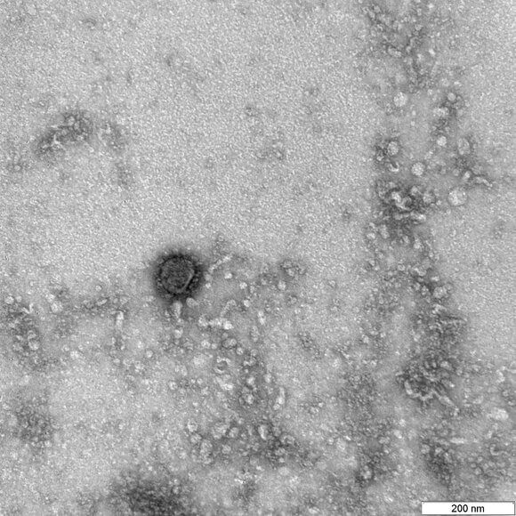 Как коронавирус атакует тело и причем здесь иммунитет. С помощью тонких нитей, которые исследователи назвали щупальцами, коронавиурс протыкает клетки, ускоряя заражение. Фото.