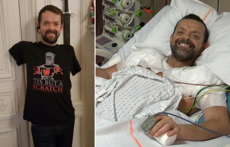 Пересадка утраченных конечностей. Феликс Гретарссон до и после хирургической операции. Фото.