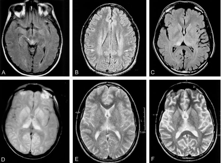 Мораторий на изучение прионов. Сканирование мозга пациента с болезнью Крейтцфельдта-Якоба. Фото.