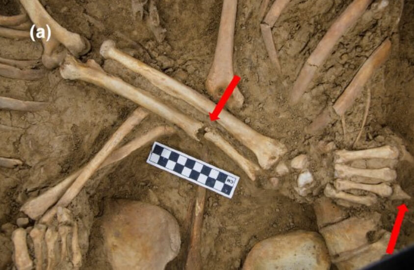 Сломанная кость руки мужчины и след отсутствия пальца. Фото.