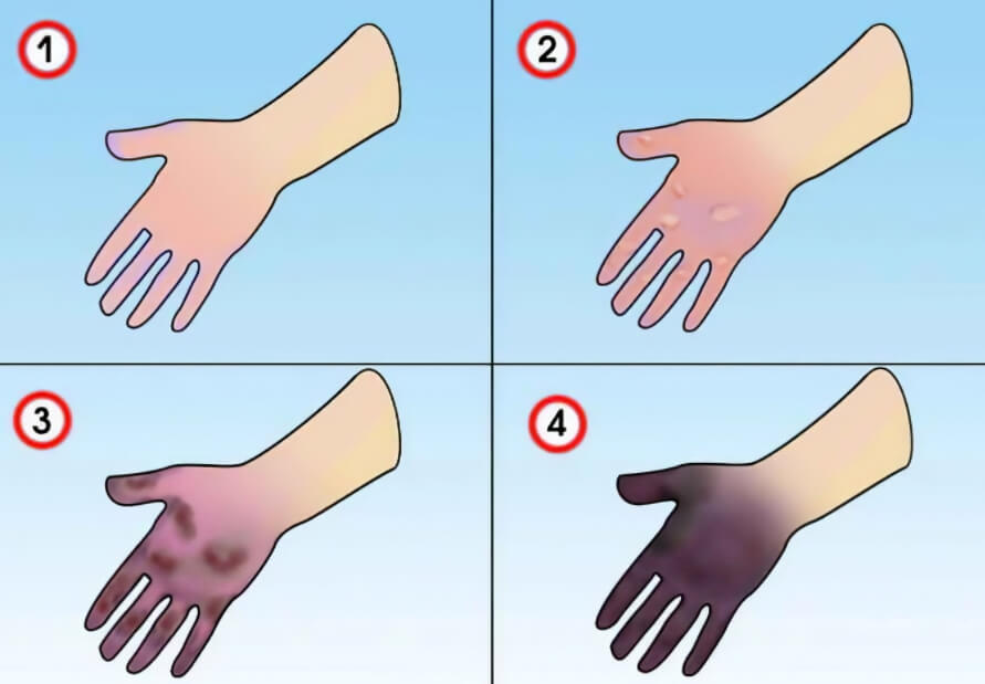 При обморожении у человека начинают чернеть конечности. Фото.