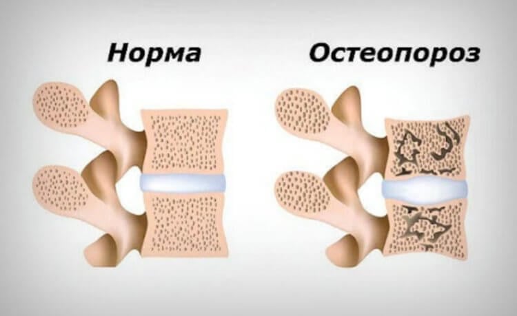 Опасность снижения роста. Нормальная структура позвонков и структура при остеопорозе. Фото.