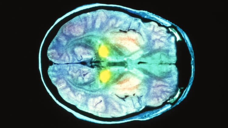 Прионы – необычные инфекционные агенты. Нейродегенеративные заболевания, вызваны прионами, буквально превращают мозг в губку. Фото.