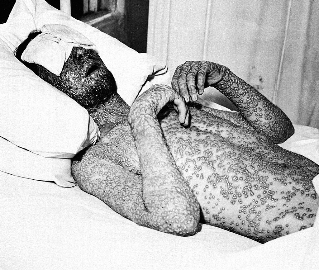 Так выглядел зараженный Оспой, болезнью, о которой мы забыли. Фото.