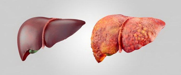 Лечение воспаления печени белком HDL3. Слева здоровая печень, а справа пораженная фиброзом. Фото.