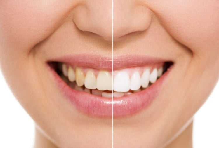 Как отбеливатели для зубов приводят к их разрушению? Отбеливатели зубов могут им навредить. Фото.