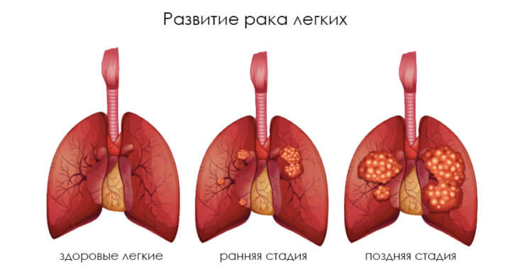 Почему рак легких возникает у некурящих людей и каким он бывает?
