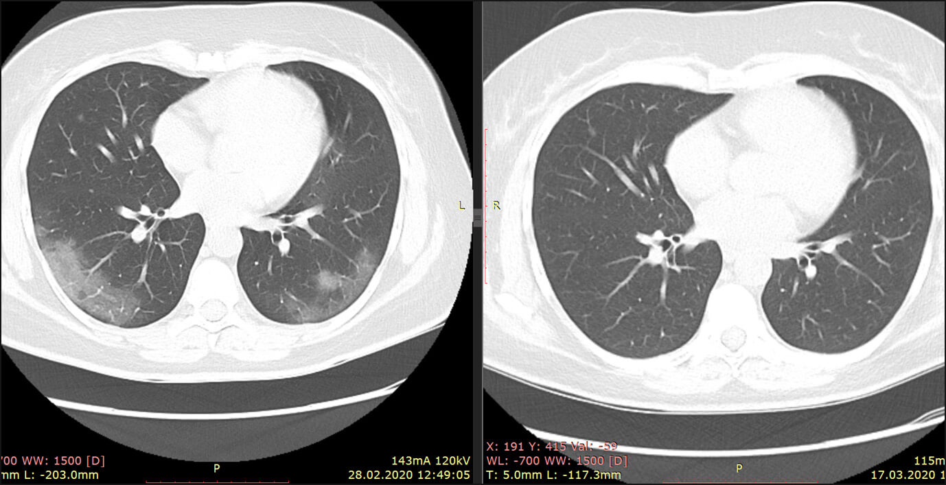 Ковидная пневмония сильно отличается от бактериальной. Фото.