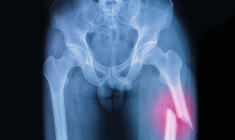 Риск переломов костей выше почти в два раза. Перелом бедренной кости у вегетарианцев случается более чем в два раза чаще, чем у людей, которые едят мясо. Фото.