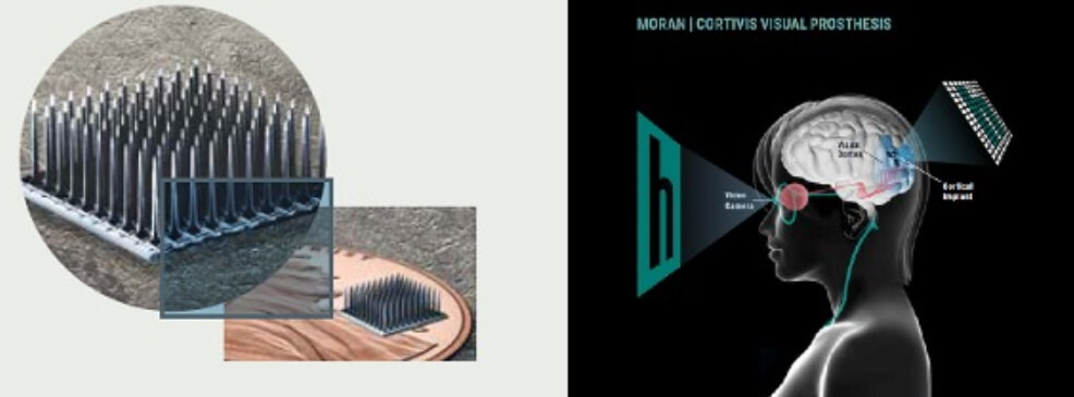 Внешний вид и принцип работы имплантата Moran Cortivis. Фото.