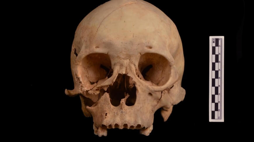 “Расхититель гробниц” ни в чем не виноват. Череп «расхитителя гробниц» содержит серьезные повреждения. Фото.