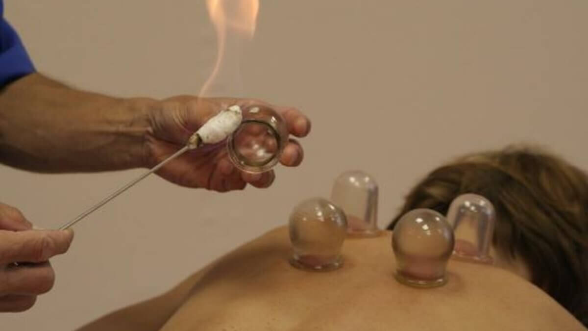 Воздух внутри банок разогревают, в результате чего они втягивают кожу как присоски. Фото.