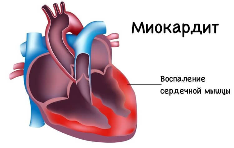 Миокардит — побочный эффект коронавируса. Миокардит — воспаление мышцы сердца. Фото.