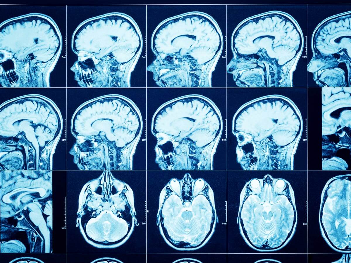 Заражает ли коронавирус мозг? С помощью МРТ сканирования мозга врачи могут диагностировать различные опасные заболевания. Фото.