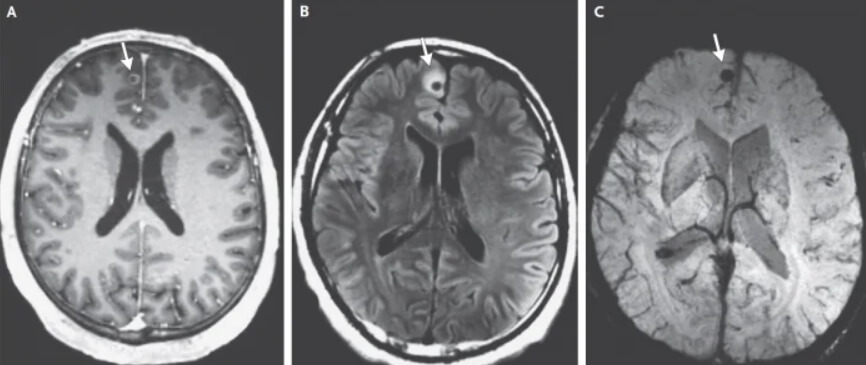 Что такое нейроцистицеркоз? Пораженные участки мозга 38-летнего мужчины. Фото.