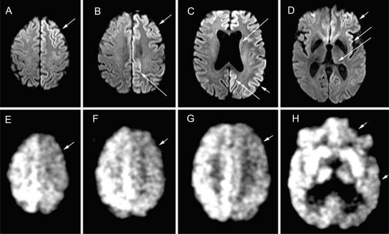 Коронавирус и прионные болезни. Под воздействием прионов мозг начинает разрушаться и медленно угасать. Фото.