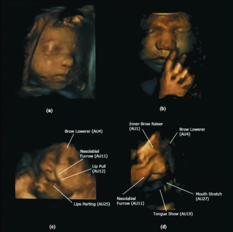 Что такое «гештальт-крики»? Мимика плачущих в утробе детей называется «гештальт-криками». Что такое «гештальт-крики»? Мимика плачущих в утробе детей называется «гештальт-криками». Фото.