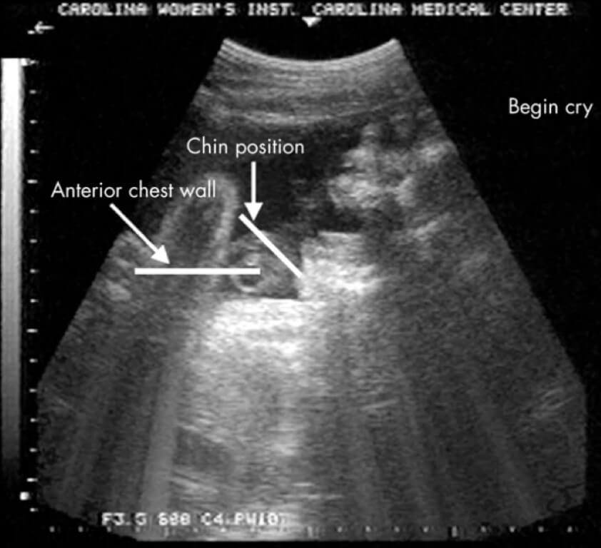 Плач детей в утробе матери. Расположение передней грудной стенки и подбородка во время плача. Плач детей в утробе матери. Расположение передней грудной стенки и подбородка во время плача. Фото.