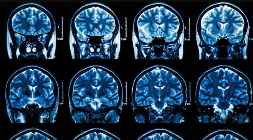 SARS-CoV-2 поражает разные органы человека, в том числе мозг. Фото.
