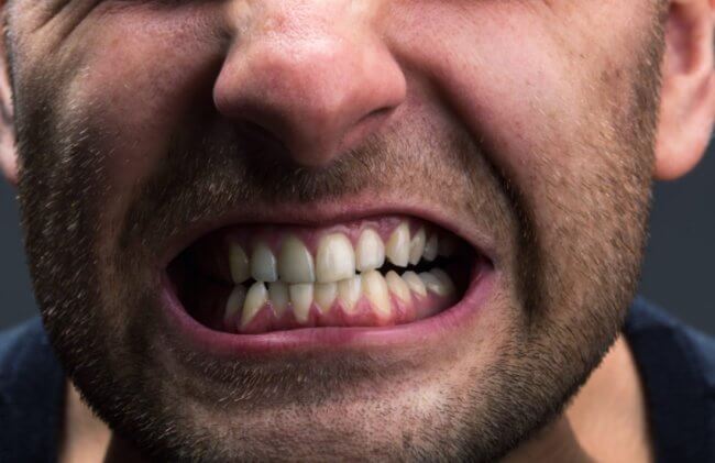 Почему люди скрипят зубами во сне и что с этим делать? Фото.