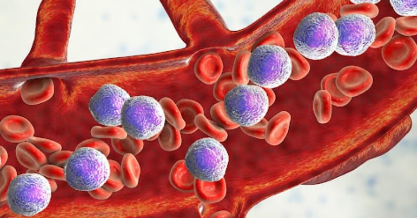 Лейкоз — опасное онкологическое заболевание, которое часто не лечится. Фото.