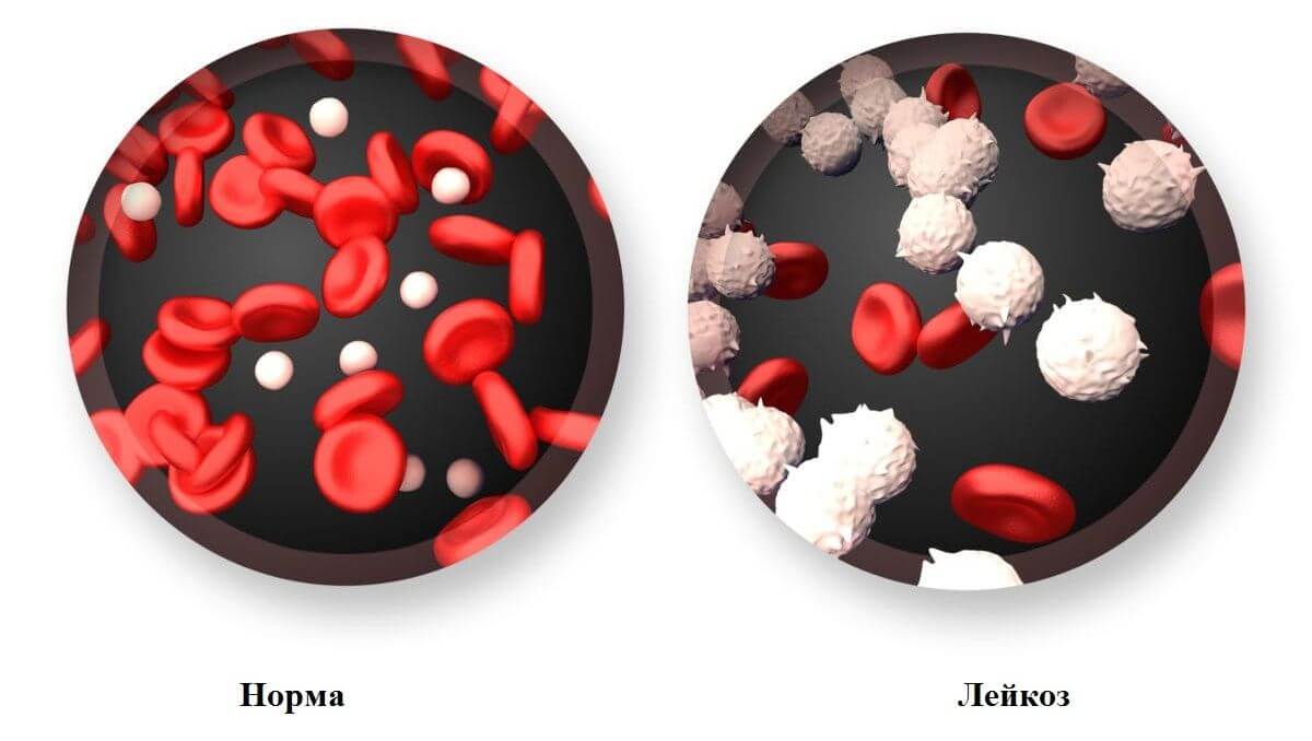Сравнение здоровой крови и крови с лейкозом. Фото.