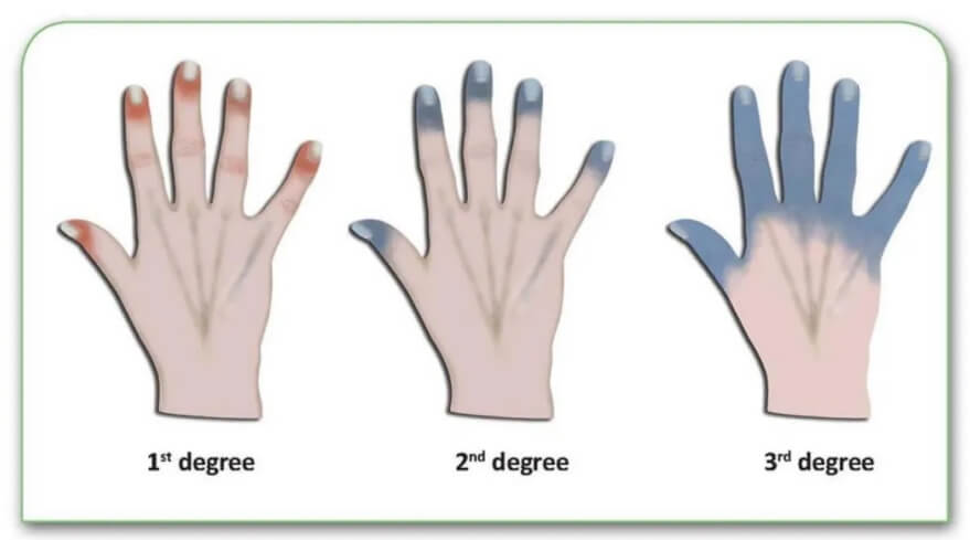 Что такое обморожение? Степени обморожения. Фото.
