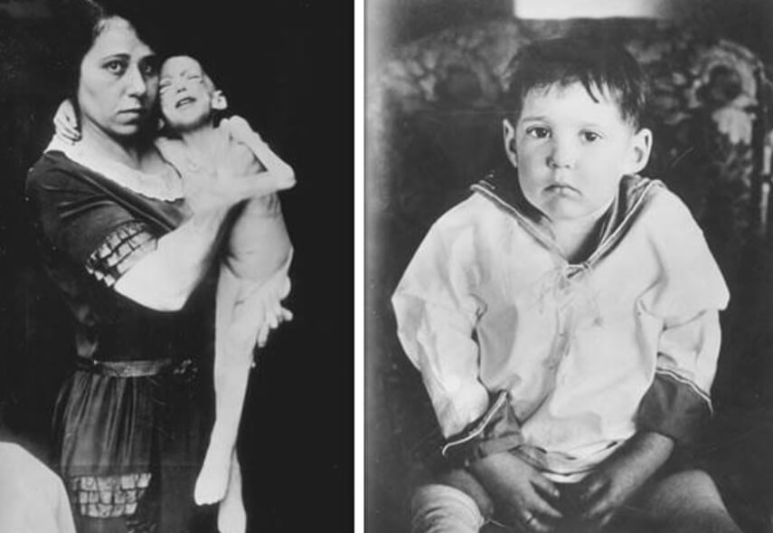 Леонарду Томпсону до и после инъекции инсулина. Фото.