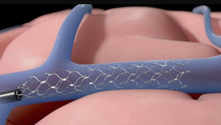 Чип Synchron внутри кровеносного сосуда. Фото.