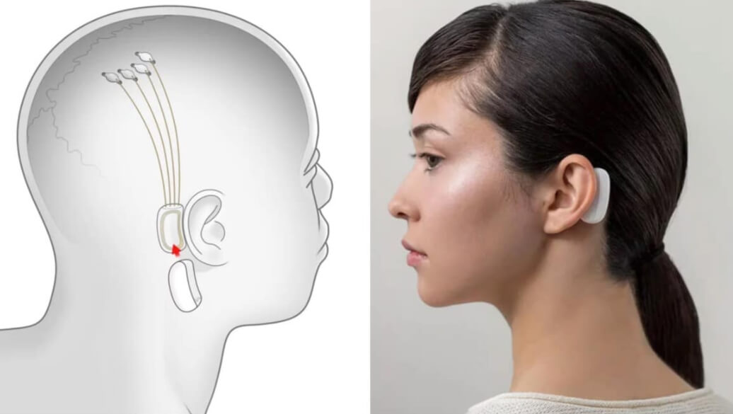 Считается, что модуль Neuralink будет практически незаметен. Фото.