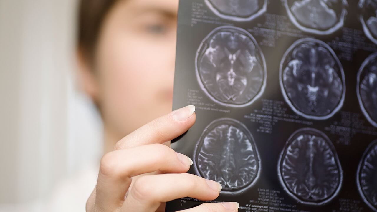 Смерть от прионных заболеваний неизбежна. Фото.