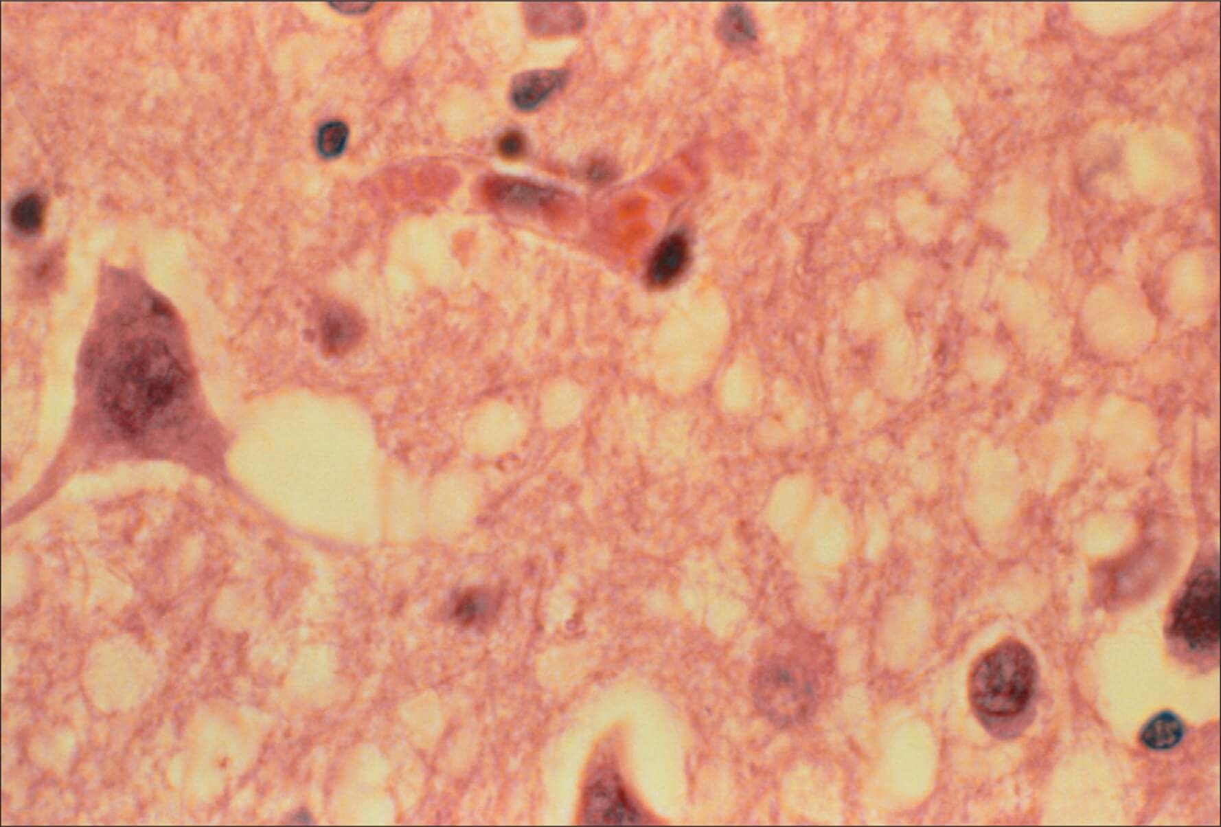 Прионы превращают мозг в губку. Фото.