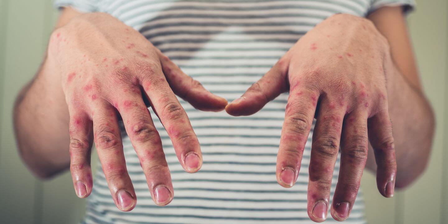 Ящур у человека проходит, в среднем, в течение двух недель. Фото.