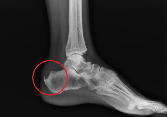 Костяные наросты могут возникать не только на шее, но и других частях тела. Фото.