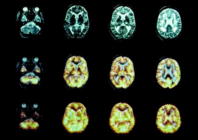 Мозг психопата работает иначе, чем у обычных людей. Фото.