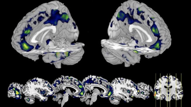 Работа мозга и ее изучение. С помощью сканирования мозга можно узнать, например, влияние на мозг коронавирусной инфекции. Фото.