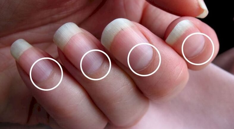 У некоторых людей лунулы на ногтях могут отсутствовать, особенно часто их нет на мизинцах. Фото.